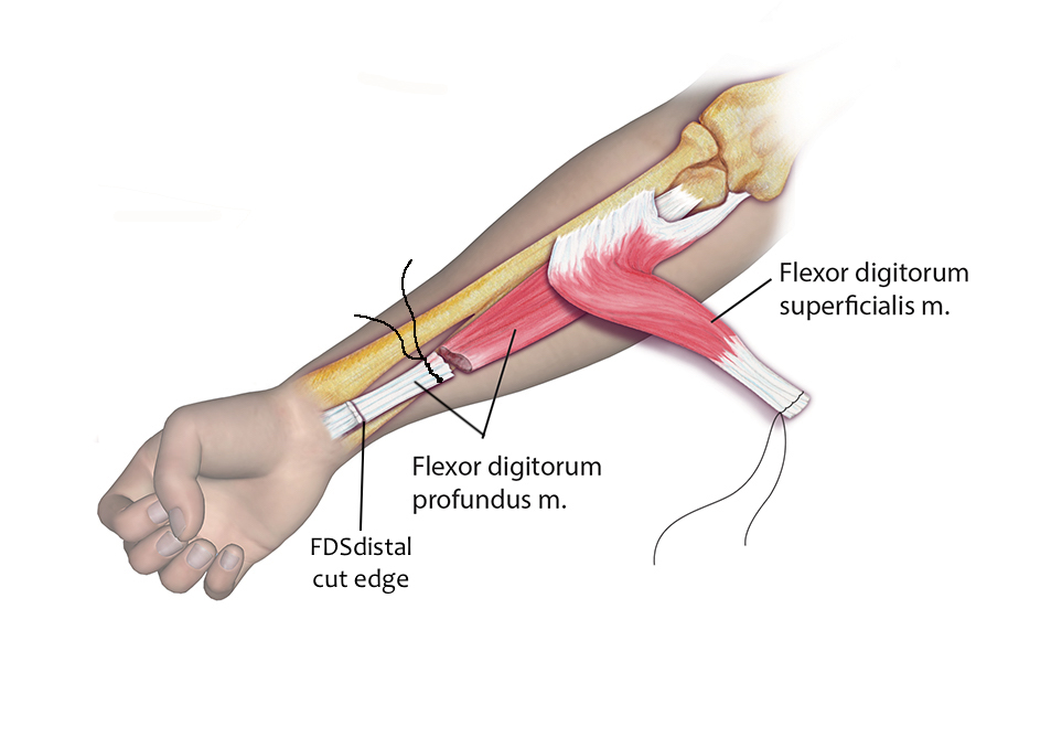 STROKE (CVA) Hand Surgery Resource